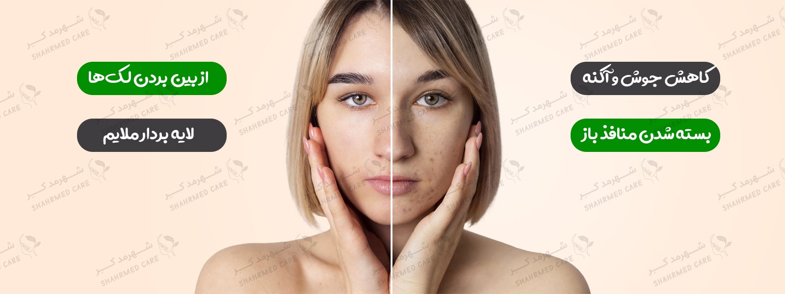 ماسک لایه بردار سالسیلیک اسید 2% اوردینری